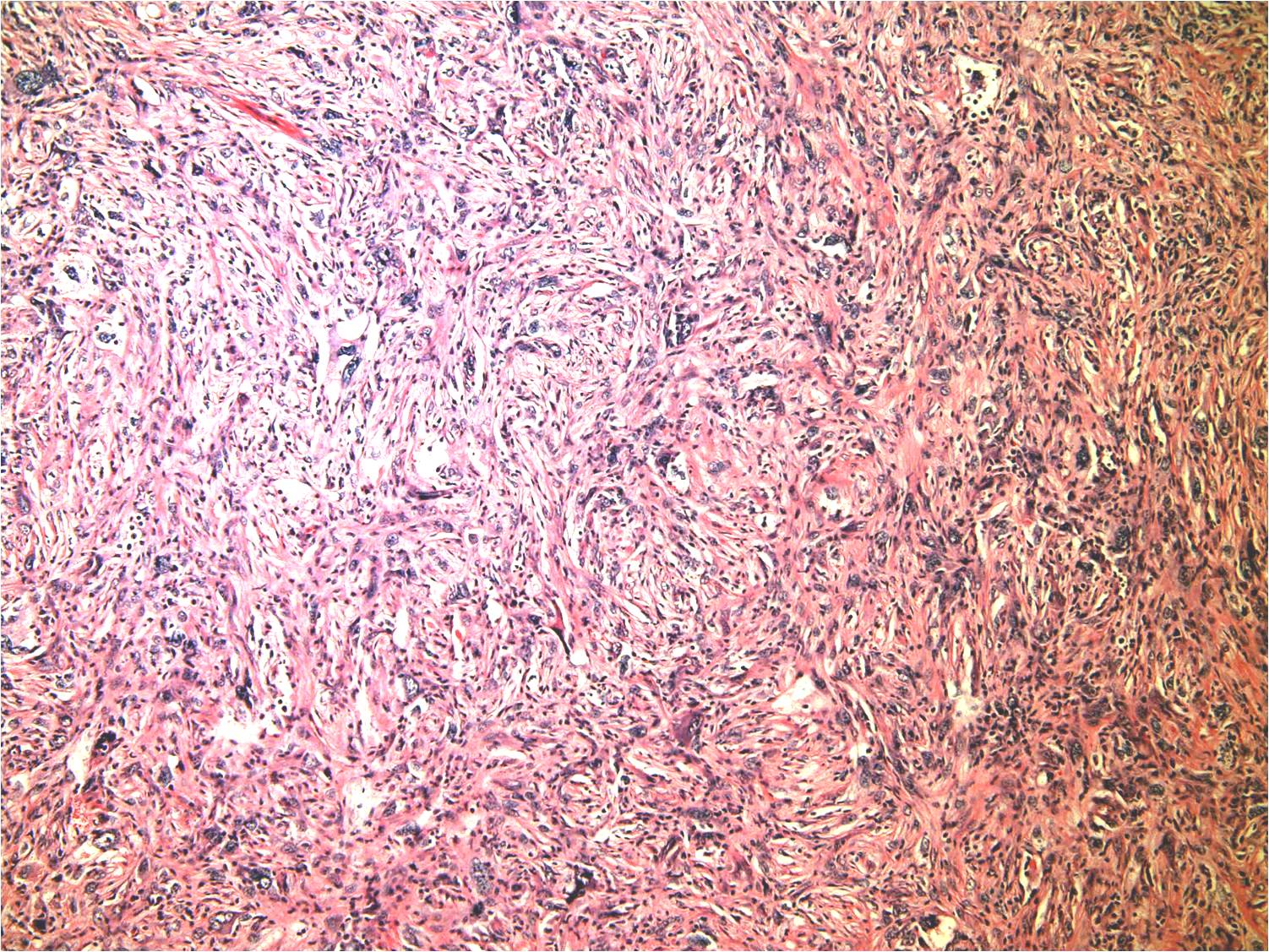 Malignant Fibrous Histiocytoma (MFH) of Bone